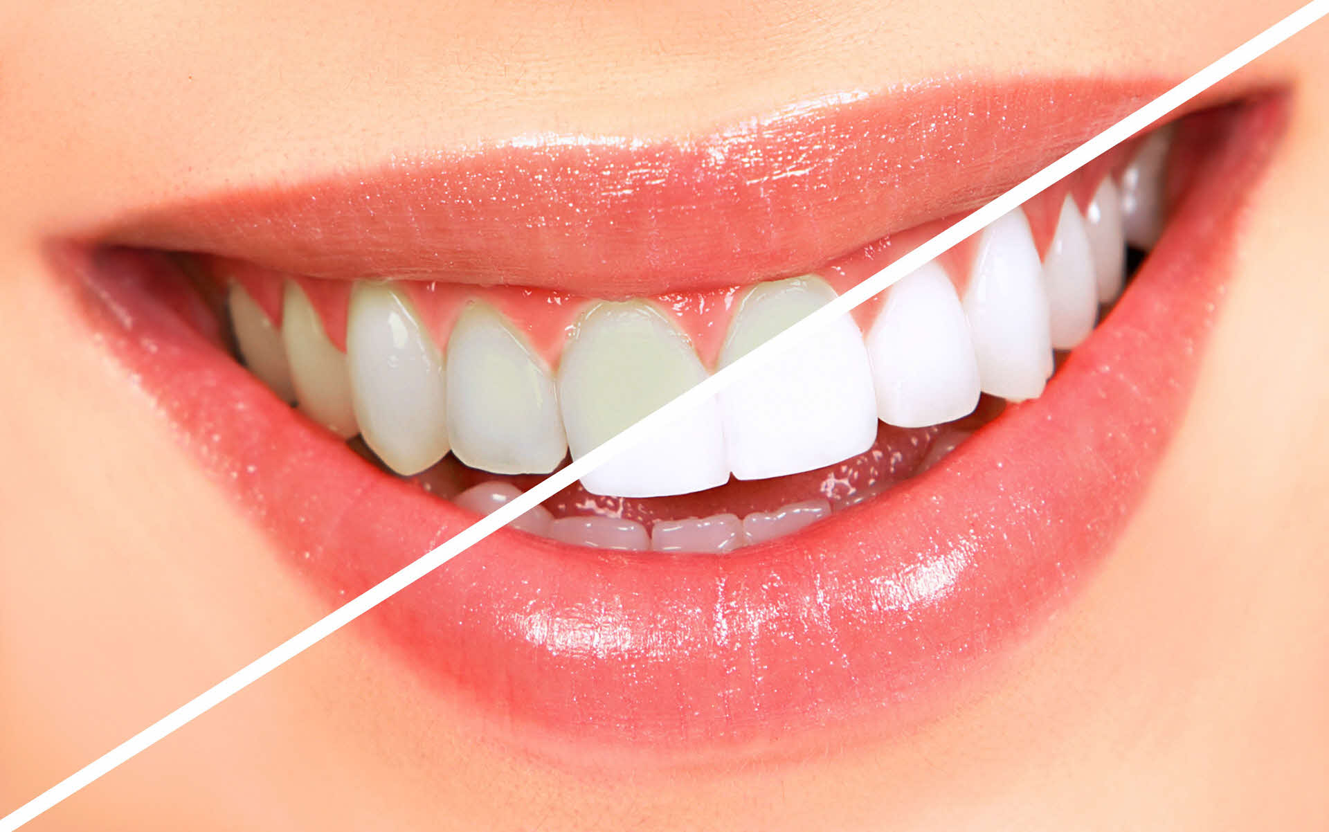 como fazer o clareamento dental caseiro
