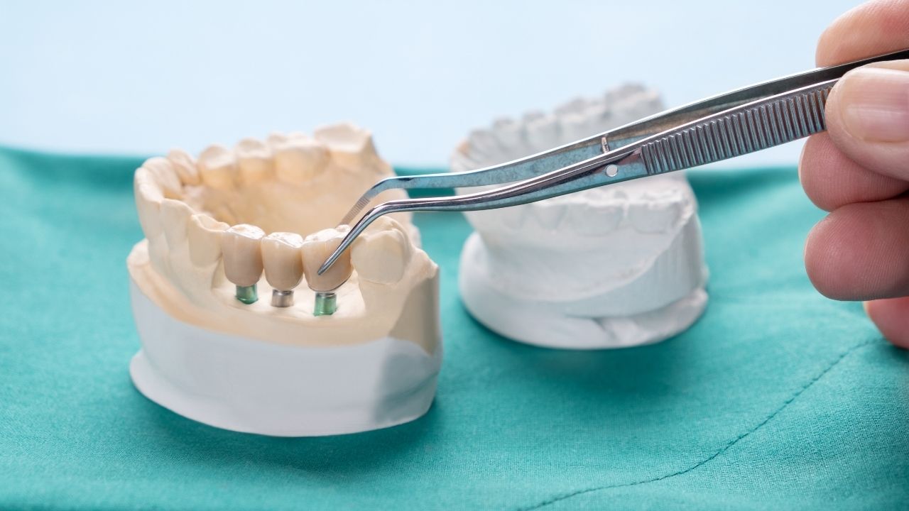 Como é feito implante dentário