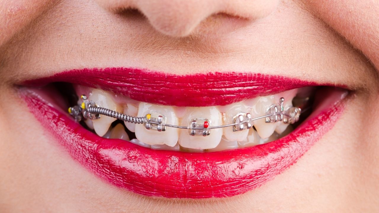 Featured image of post Dente Encavalado Da Frente Tratamentos de canal pr tese restaura o dente da frente