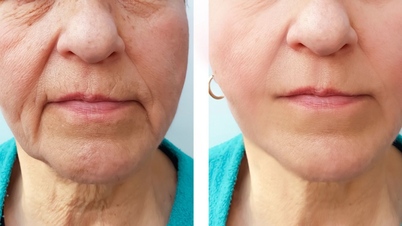 Botox no rosto antes e depois