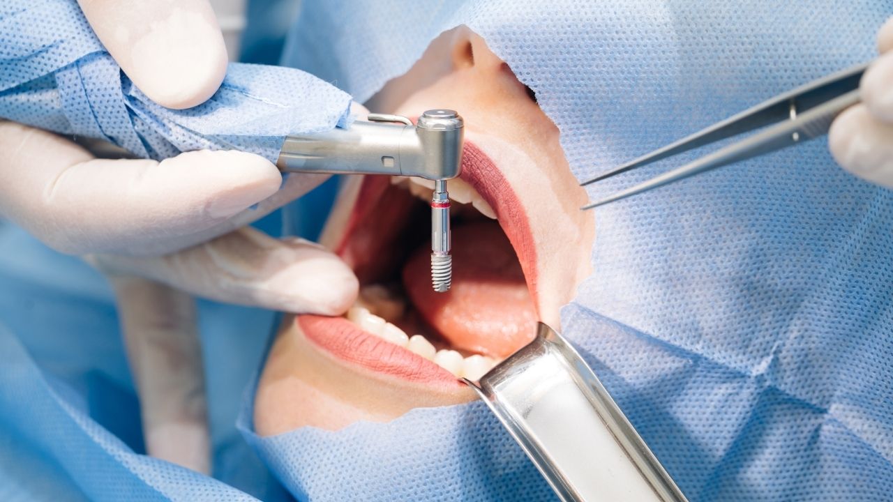 quais as indicações do implante dentário