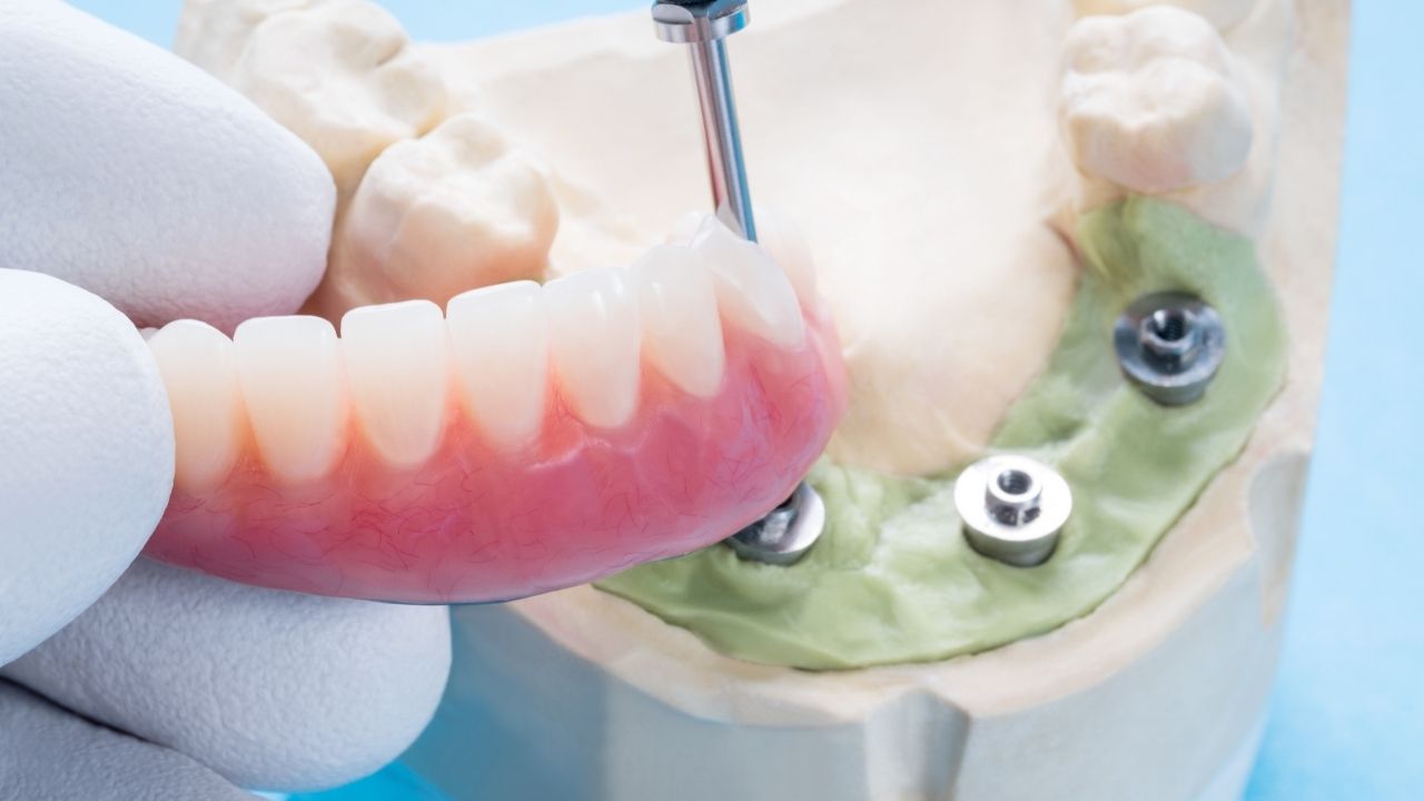 quais as técnicas usadas na implantodontia