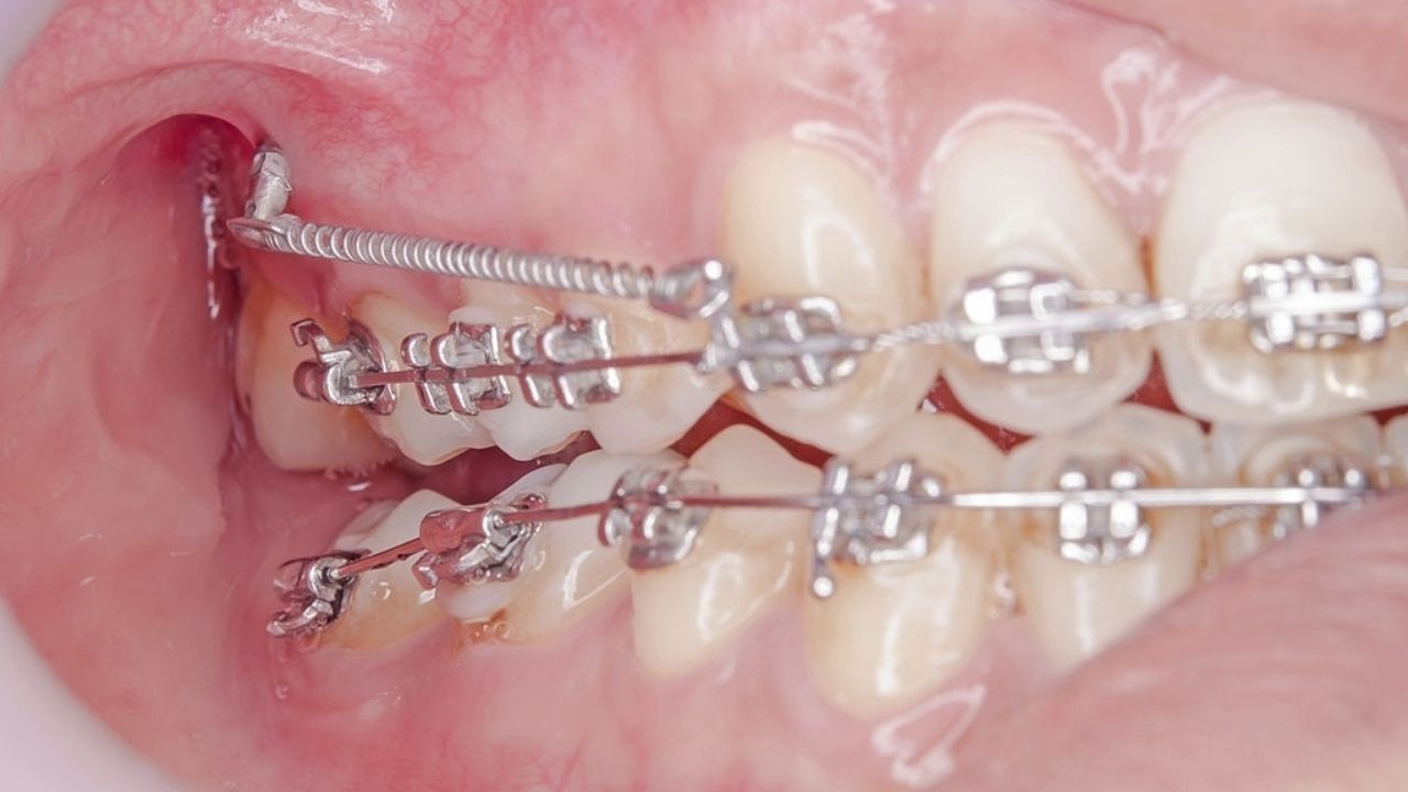 mini implante ortodontico antes e depois