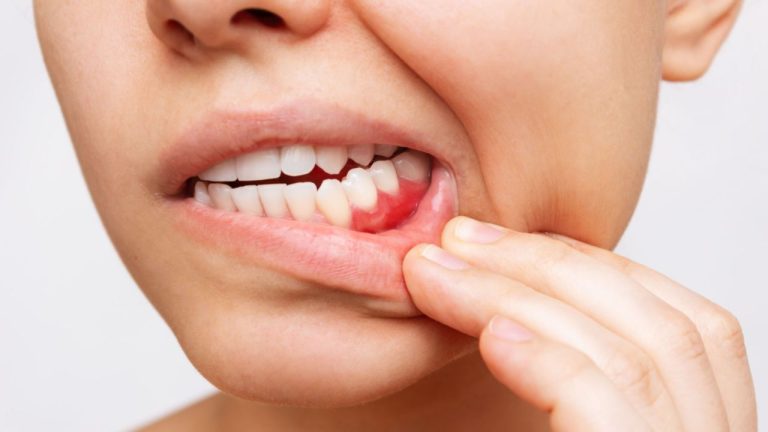 Gengiva branca: conheça as causas e tratamentos - Clinica OralDents