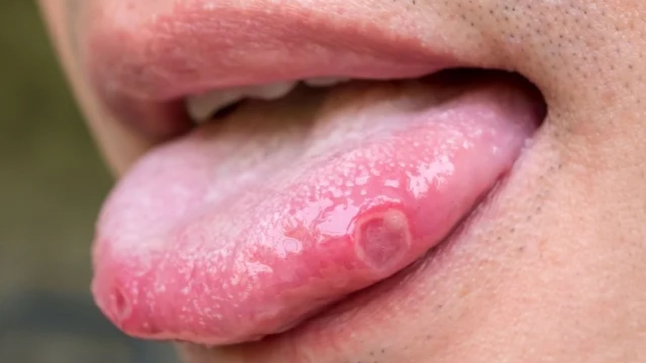bolinha na língua