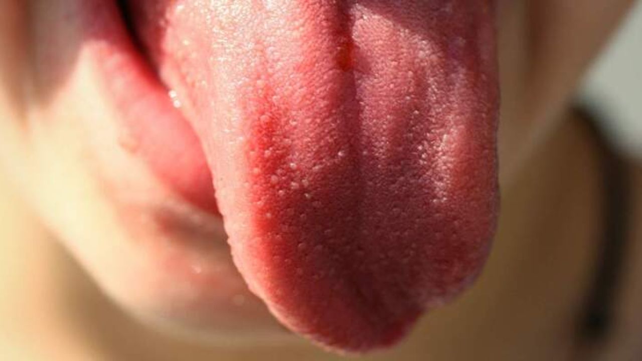 bolinhas brancas na lingua